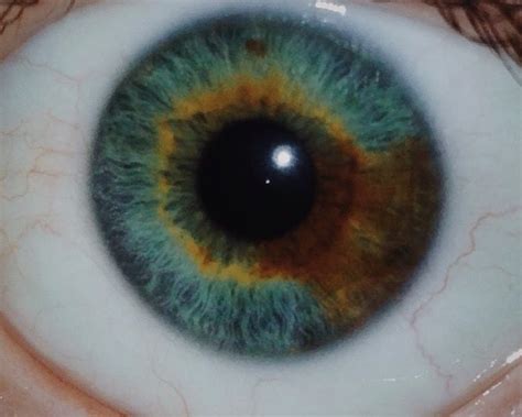 Central Heterochromia 2 Eye Colors Causes And Treatments