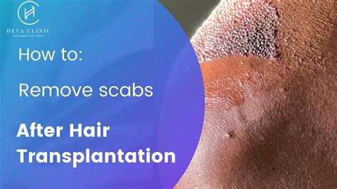 How To Get Rid Of Scabs After Hair Transplant Heva Clinic Youtube