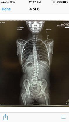 Pectus excavatum, cunoscut drept pieptul infundat, este o deformare congenitala a peretelui toracic in care citeva coaste si sternul se dezvolta anormal, producind un aspect concav sau excavat al peretelui toracic anterior. 4 year old scoliosis, nf1 and pectus excavatum | Scoliosis ...