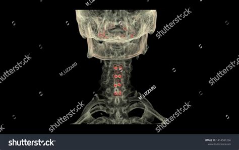 3d Computed Tomography Ct Cervical Spine Stock Illustration 1414581266