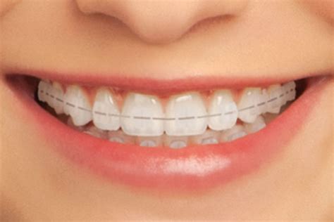 Clear Braces Teeth And Braces Clinic Indore