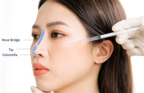 Non Surgical Nose Augmentation Hiko Nose Threadlift Vs Dermal Fillers