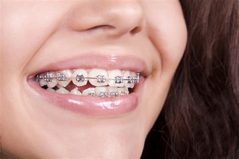 From making bread and plunging toilets to cutting hair and giving manicures. How to Keep My Braces Clean - Orthodontics Limited