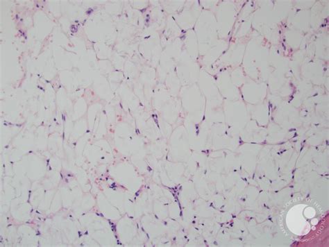 Aplastic Anemia And Paroxysmal Nocturnal Hemoglobinuria Biopsy