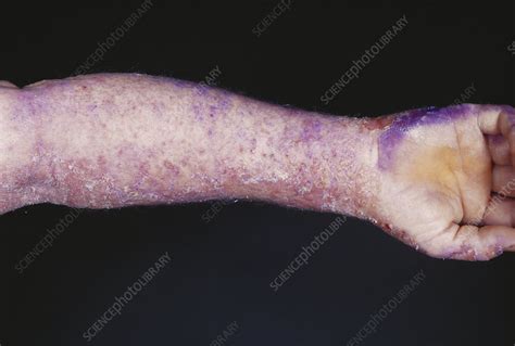 Eczema Stock Image C0175676 Science Photo Library