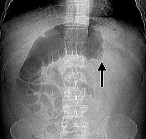 Large Bowel Obstruction In The Adult Classic Radiographic And CT Findings Etiology And Mimics