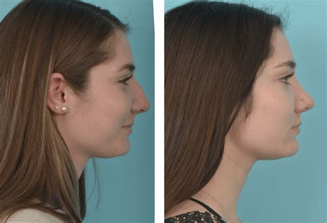 Rhinoplasty Utah Mobley Md Facial Plastic Surgeon