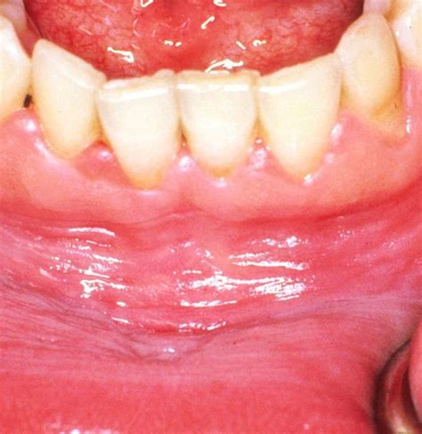Grey Near Gums Grey And Black Gums After Professional Teeth Whitening