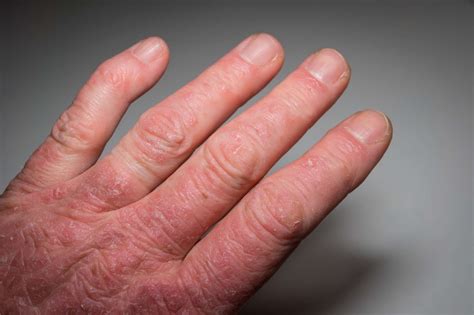 Clinical Features Of Psoriatic Arthritis