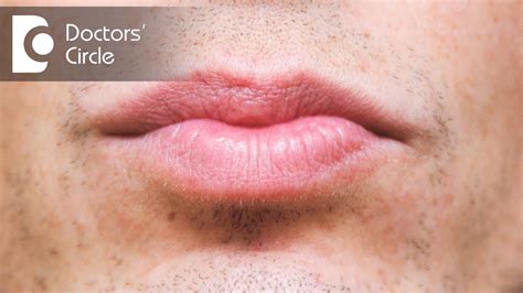 How To Get Rid Of White Patches On Lower Lip Lips Makeupview