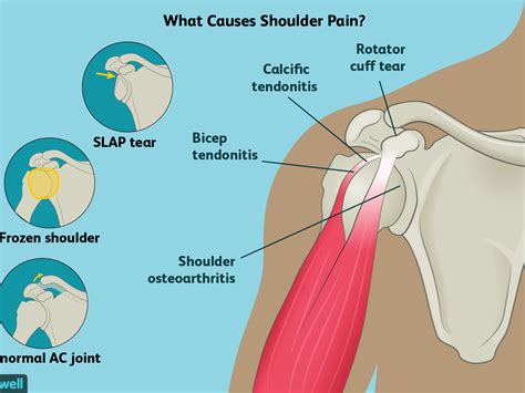 Shoulder pain doesn't have to be a fact of life. Understanding the Shoulder - Doctor Shoulder