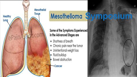 Video Mesothelioma Causes Mesothelioma Diagnosis Mesothelioma
