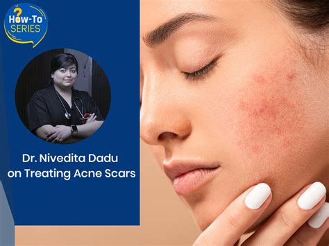 How To Treat Acne Scars Dermatologist Dr Nivedita Dadu Shares Tips