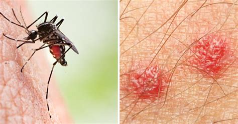 Do Your Mosquito Bites Swell And Sting It Is Possible You Have
