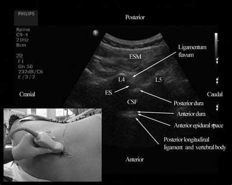 Real Time Ultrasound Guided Paramedian Epidural Access Evaluation Of A Novel In Plane Technique