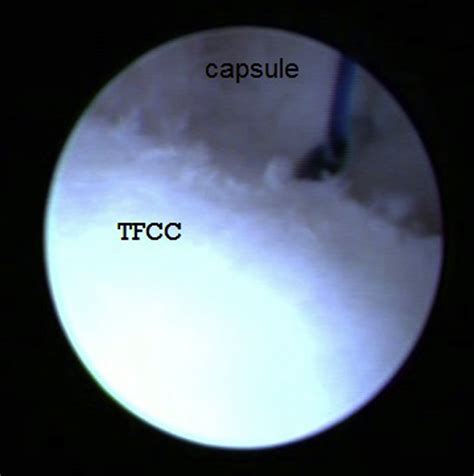 Arthroscopic Treatment Of Type 1b Triangular Fibrocartilage Complex