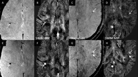 Longitudinal Magnetic Resonance Imaging Of Cerebral Microbleeds In