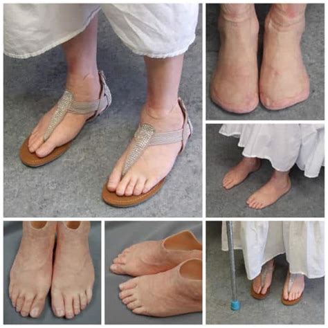 Toe And Foot Photo Gallery Medical Art Prosthetics