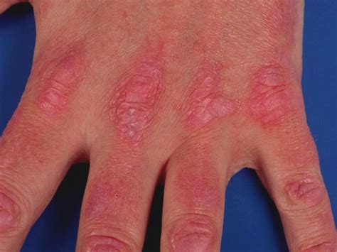 Dermatomyositis Skin Rash