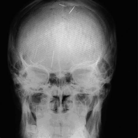 Dandy Walker Malformation A Axial Us Mastoid View Shows Dilatation Of