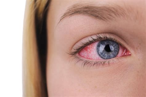 Red Sore Eye Stock Photo Download Image Now Istock