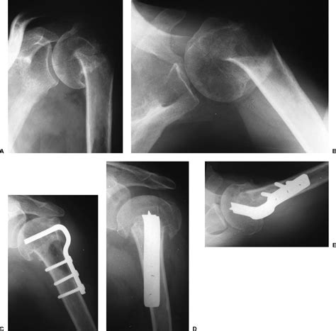 Proximal Humerus And Humeral Diaphyseal Fractures Musculoskeletal Key