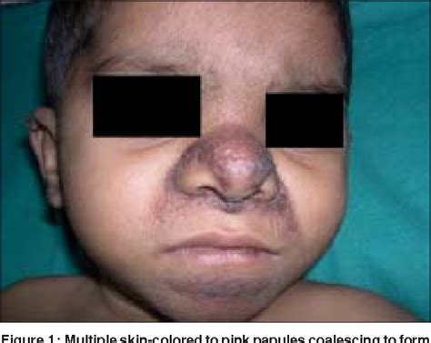 Figure 1 From Juvenile Hyaline Fibromatosis And Infantile Systemic