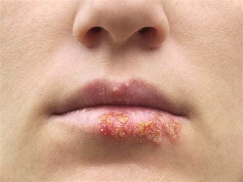 Herpes Types Symptoms Causes Treatments Organic Facts