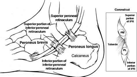Peroneal Tendon Tears And Instability Foot And Ankle Orthobullets