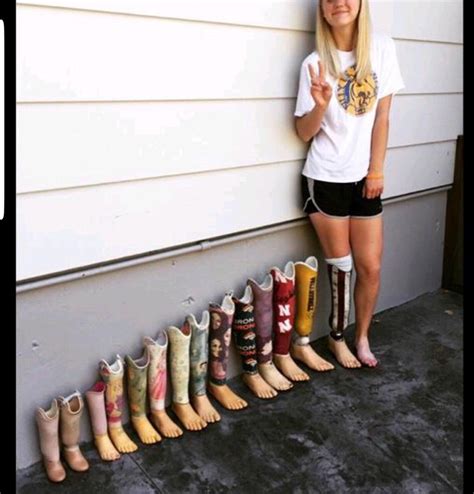 girl displays her prosthetic leg progression complete with a nebraska prosthetic r huskers