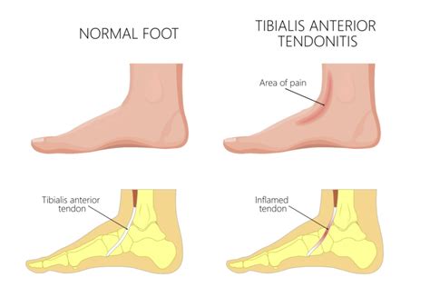 Tibialis Anterior Tendonitis A Cause Of Mid Foot Pain