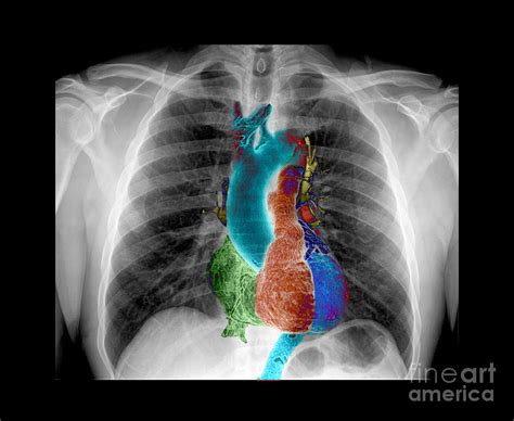 X Ray Chest Heart