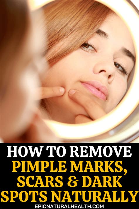 How To Remove Pimple Marks Scars And Dark Spots Naturally Epic Natural