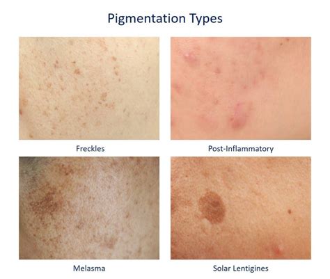 How To Remove Hyperpigmentation And Freckles Tips And Treatment