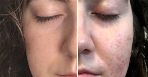 This is an example of the effects of tretinoin after 11 years of constant use (at the time the second photo was taken). Tretinoin (Retin-A) - Before and After Acne | Katie McManus