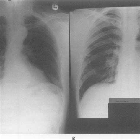 Chest X Rays Showing The Solitary Lung Cyst In The Right Middle Lobe