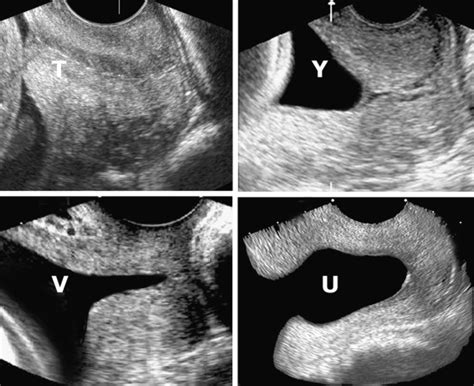 Ultrasound Evaluation Of The Gravid Cervix Radiology Key
