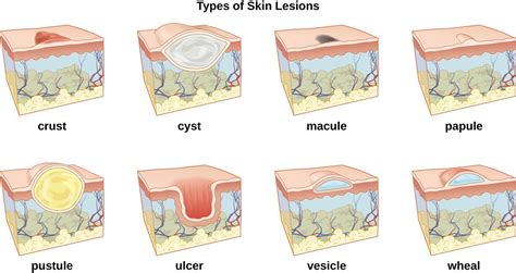 A raised, circumscribed area of the. Anatomy and Normal Microbiota of the Skin and Eyes ...