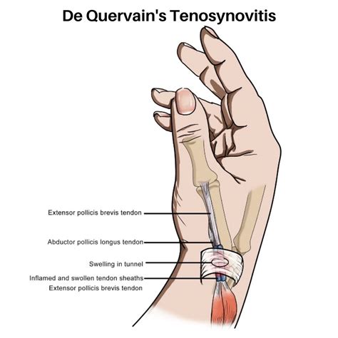 De Quervain S Tenosynovitis Orchard Health Clinic Osteopathy Physiotherapy And Chiropractic