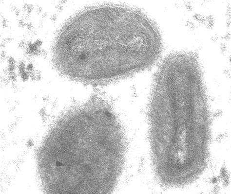 This is followed by a rash that forms blisters and crusts over. Isolated Case of Monkeypox Confirmed in Sierra Leone