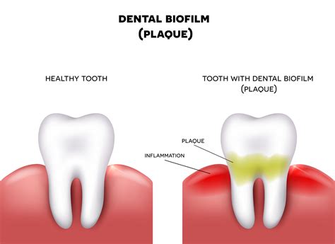 What Is Dental Plaque And How Can My Denver Dentist Help