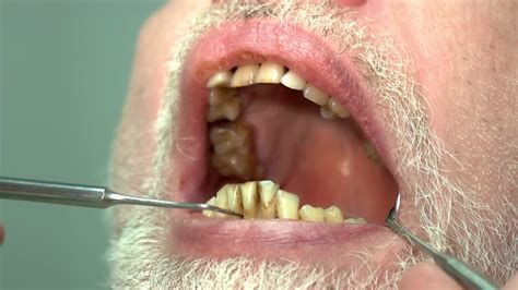 Patient Of Dentist Bad Teeth Opened Mouth And Dental Probe How To