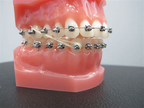 Eating can be quite a challenge with braces, particularly during the first few painful weeks and after the brackets are tightened. Boschken Orthodontics: Why Does Dr. Boschken Recommend ...