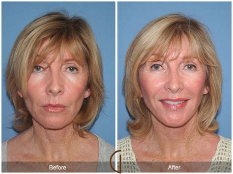 Facelift Fifties Before And After Photos Patient 59 Dr Kevin Sadati