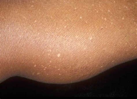 White Spots Symptoms Causes And Treatments Health Digest