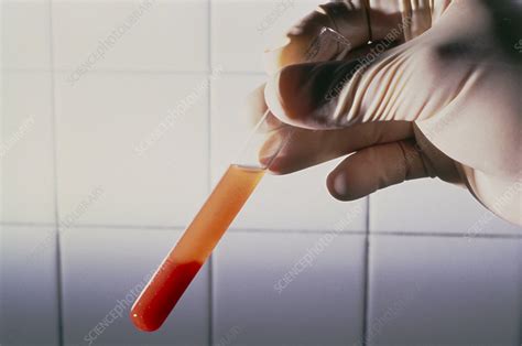 A Centrifuged Blood Sample In A Test Tube Stock Image M5300273
