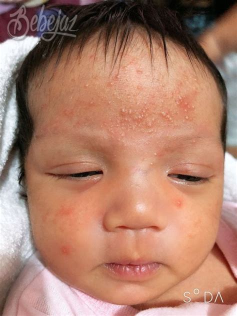 Blog My 2nd Baby Had Cradle Cap Seborrheic Dermatitis In Infants