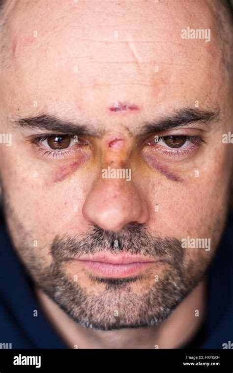 Bruised Eye Hi Res Stock Photography And Images Alamy