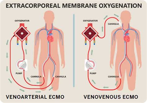 Extracorporeal Membrane Oxygenation