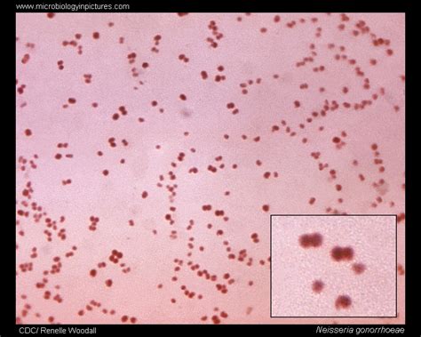 Neisseria Gonorrhoeae Gram Stain Gram Stained Smear Of Neisseria